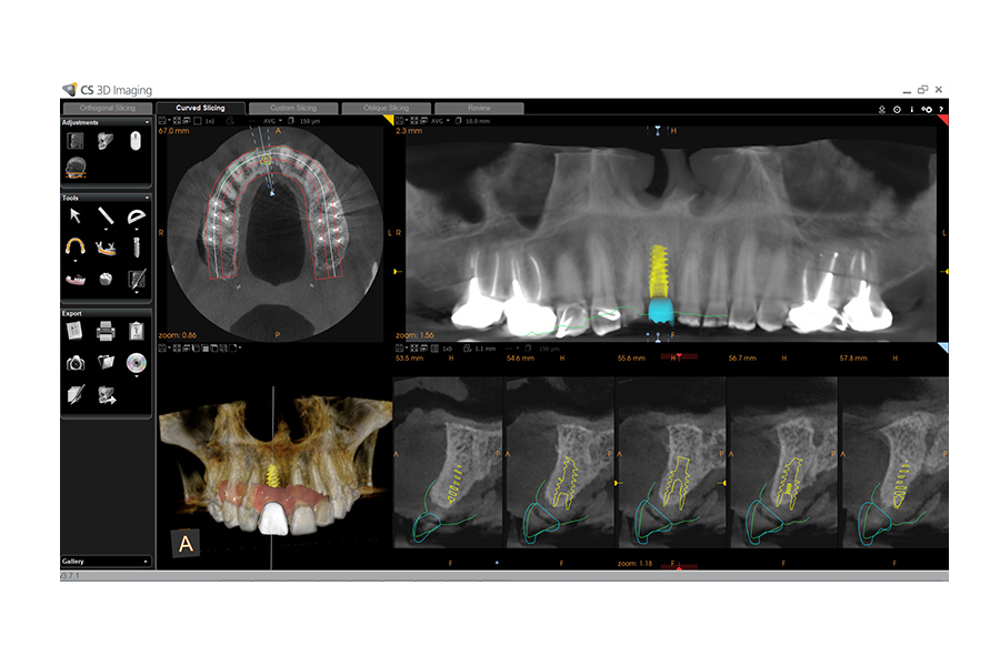 CS Solutions for implants